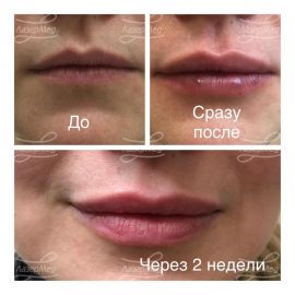 Комплексная коррекция губ Диспорт+ артфиллер «файн лайнс»