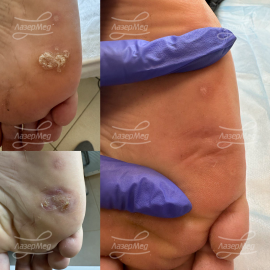 Лечение большой подошвенной бородавки лазером