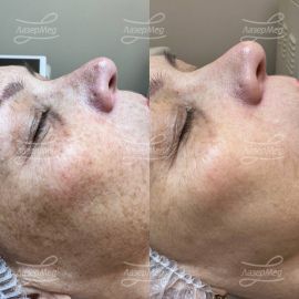 Фотоомоложение и удаление пигментных пятен на лице