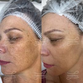 Фотоомоложение и удаление пигментных пятен на лице