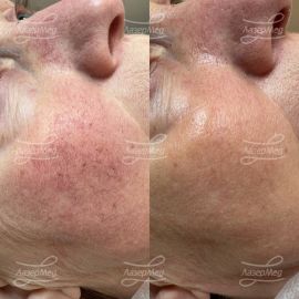 Фотоомоложение, комбинация IPL + KTP лазеров. Эффект сразу после применения.