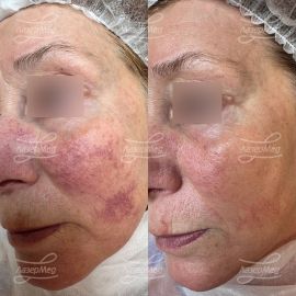 Фотоомоложение, комбинация IPL + KTP лазеров. Эффект сразу после применения.