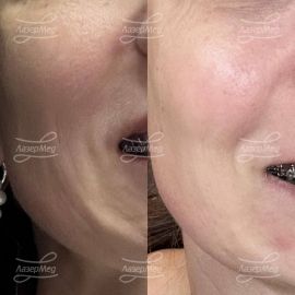 Поцедура на аппарате Venus RF, насадка Diamond polar. 6 поцедур, 1раз в неделю. Эффект после 1,5 мес.