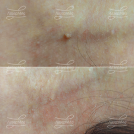 Лазерная деструкция кератомы на ножке