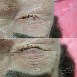 Лазерная деструкция кератомы на ножке в области подвижного века