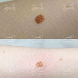 Лазерная деструкция невуса на предплечье