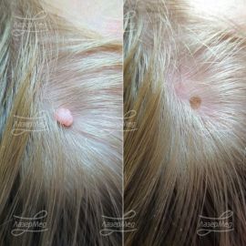 Лазерная деструкция невусов на волосистой части головы