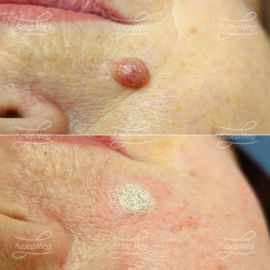 Лазерная деструкция невуса на лице