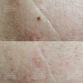 Лазерная деструкция невуса