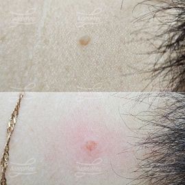 Лазерная деструкция невуса