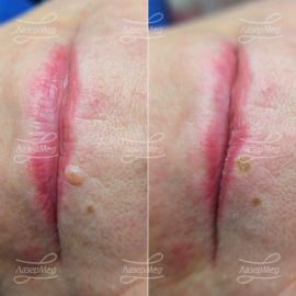 Лазерная деструкция невуса