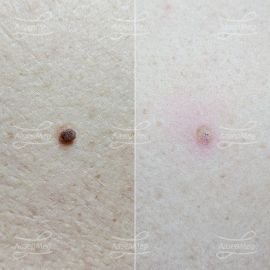 Лазерная деструкция невуса