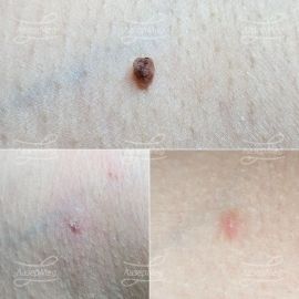 Лазерная деструкция невуса в подмышечной области