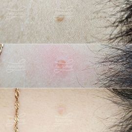 Лазерная деструкция невуса на задней поверхности шеи