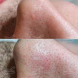 Лазерное удаление фибромы