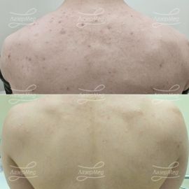 Лечение акне системными ретиноидами