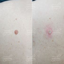 Лазерная деструкция невуса на спине