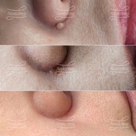 Лазерная деструкция фибромы на лице