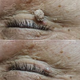 Лазерная деструкция кератомы на ножке