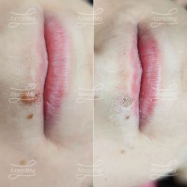 Лазерная деструкция невуса над верхней губой