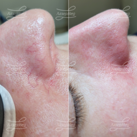 Коагуляция сосудов на крыльях носа