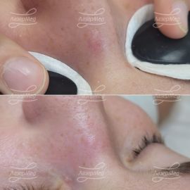 Коагуляция сосудов на спинке носа