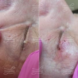 Удаление папиллом на веках