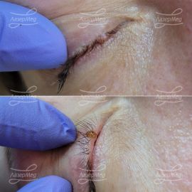 Удаление новообразования на ресничном крае века
