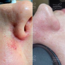 Коагуляция сосудов на лице
