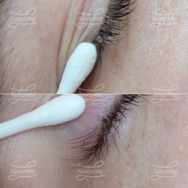 Удаление папиллом на ресничном краче века