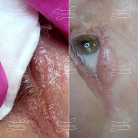 Удаление папиллом на ресничном краче века