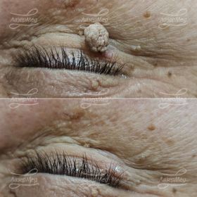 Лазерная деструкция кератомы на ножке