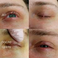 Лазерная деструкция папилломы на ресничном крае