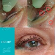 Лазерная деструкция 2 милиумов на ресничном крае верхнего века и кератомы на коже лица