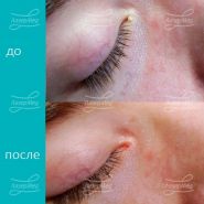 Лазерная деструкция милиума в области глаза