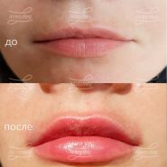 Контурная пластика губ