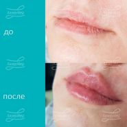 Контурная пластика губ