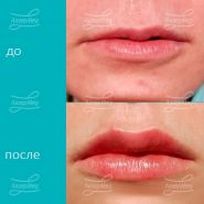 Контурная пластика губ