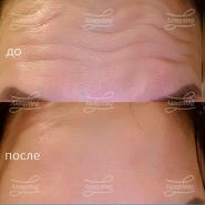 Коррекция мимических морщин ботулотоксином типа А