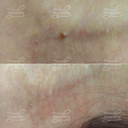 Лазерная деструкция кератомы на ножке