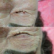 Лазерная деструкция кератомы на ножке в области подвижного века