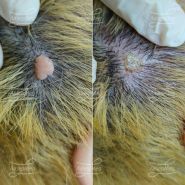 Лазерная деструкция невусов на волосистой части головы