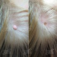 Лазерная деструкция невусов на волосистой части головы