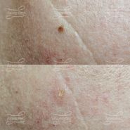 Лазерная деструкция невуса