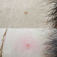 Лазерная деструкция невуса