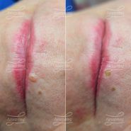 Лазерная деструкция невуса