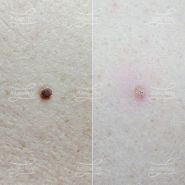 Лазерная деструкция невуса