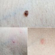 Лазерная деструкция невуса в подмышечной области