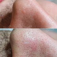 Лазерное удаление фибромы