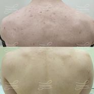 Лечение акне системными ретиноидами